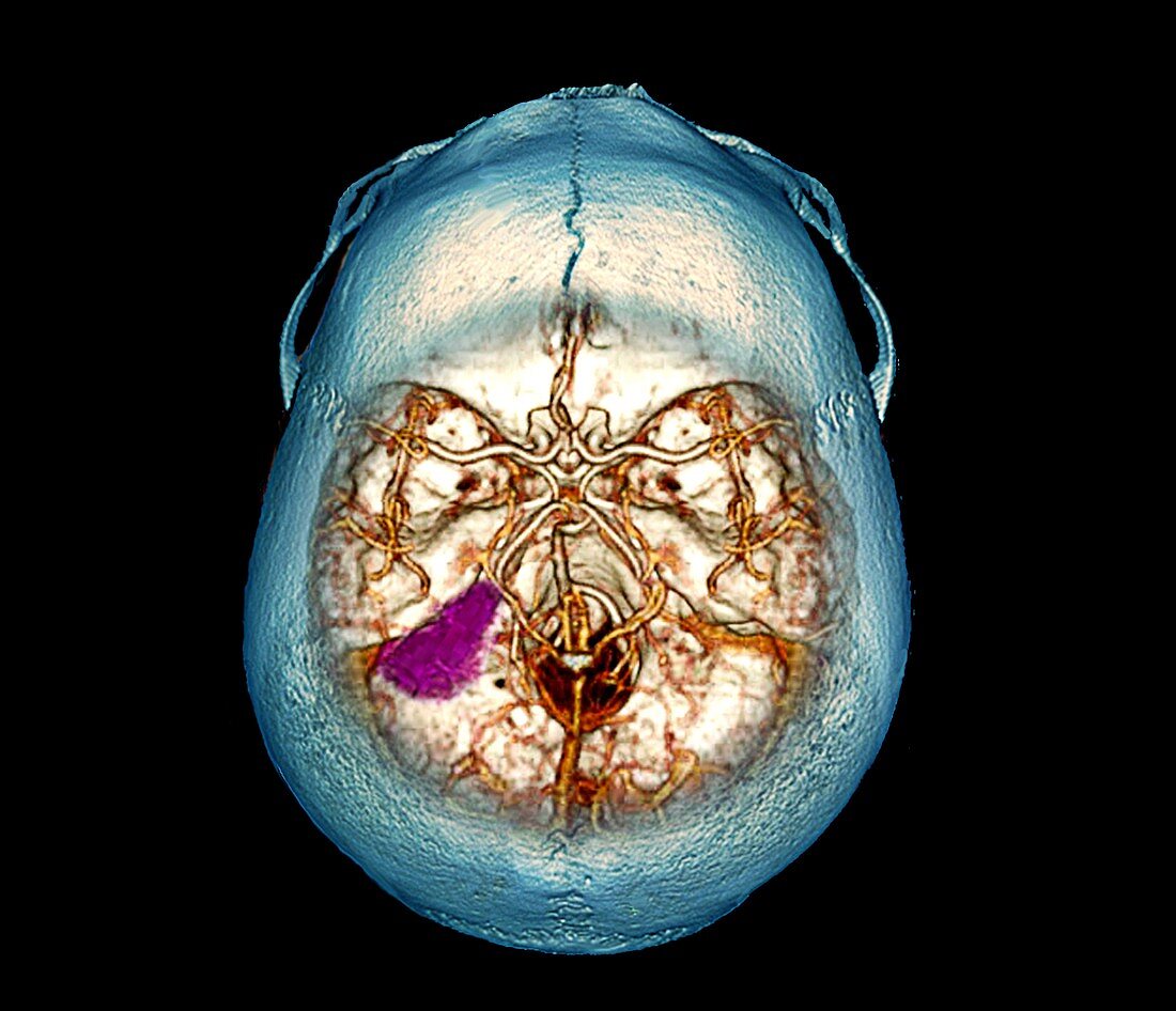 Brain tumour,3D CT scan