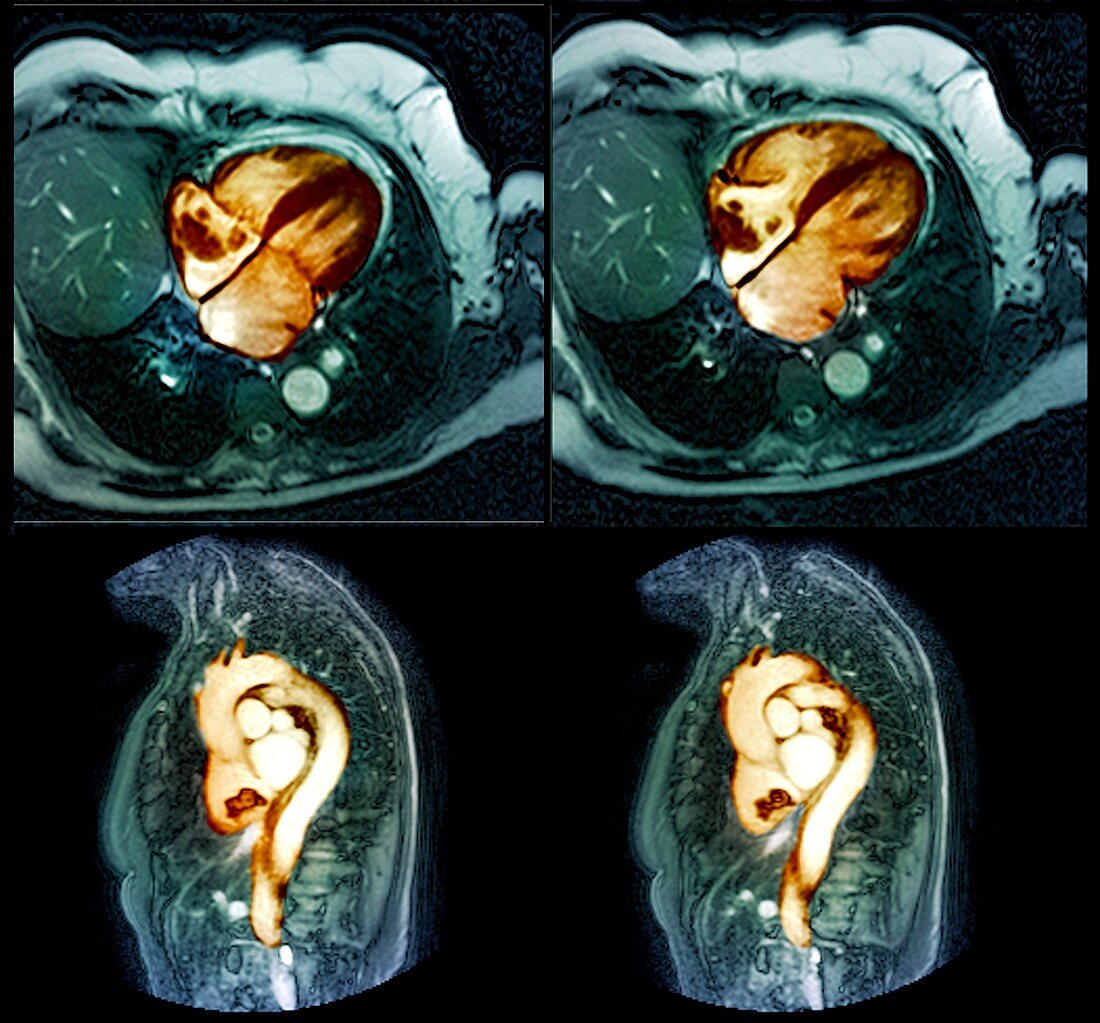 Lung cancer,MRI