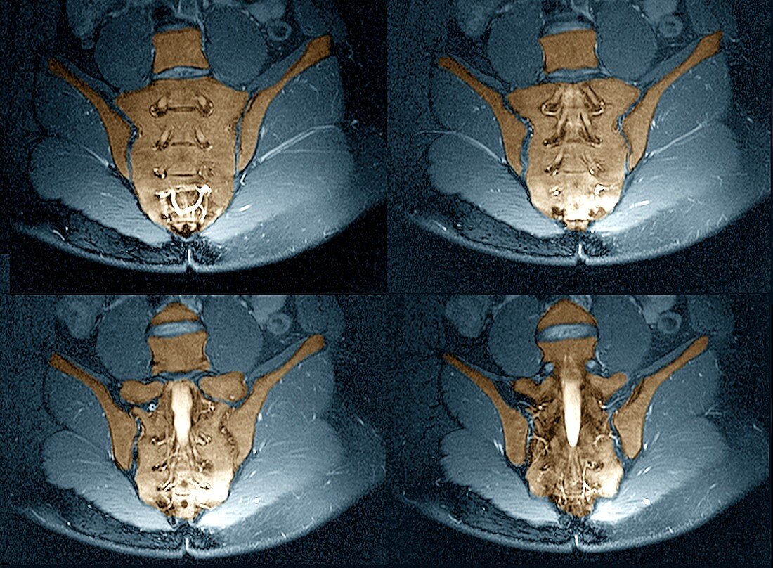 Normal sacrum,MRI