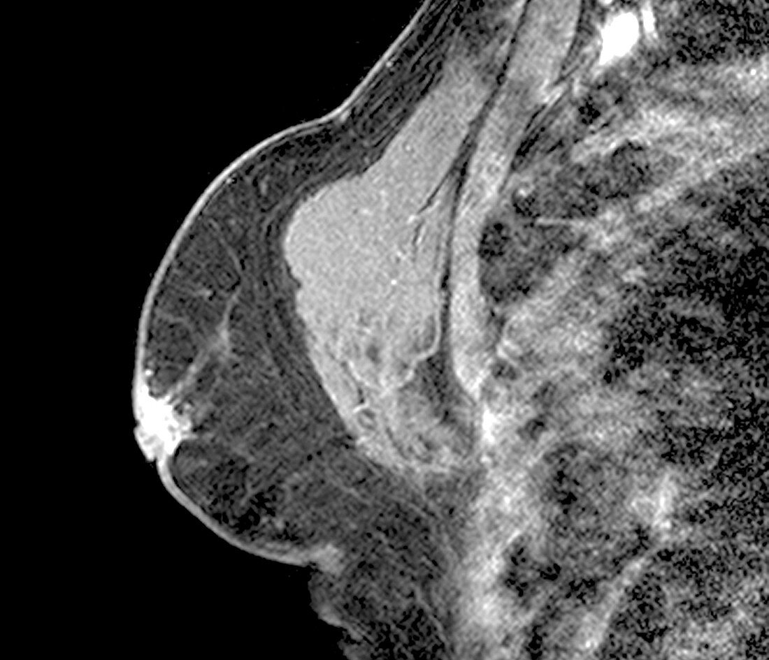 Gynaecomastia,MRI