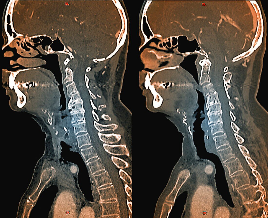Osteoarthritis of the neck,CT scans
