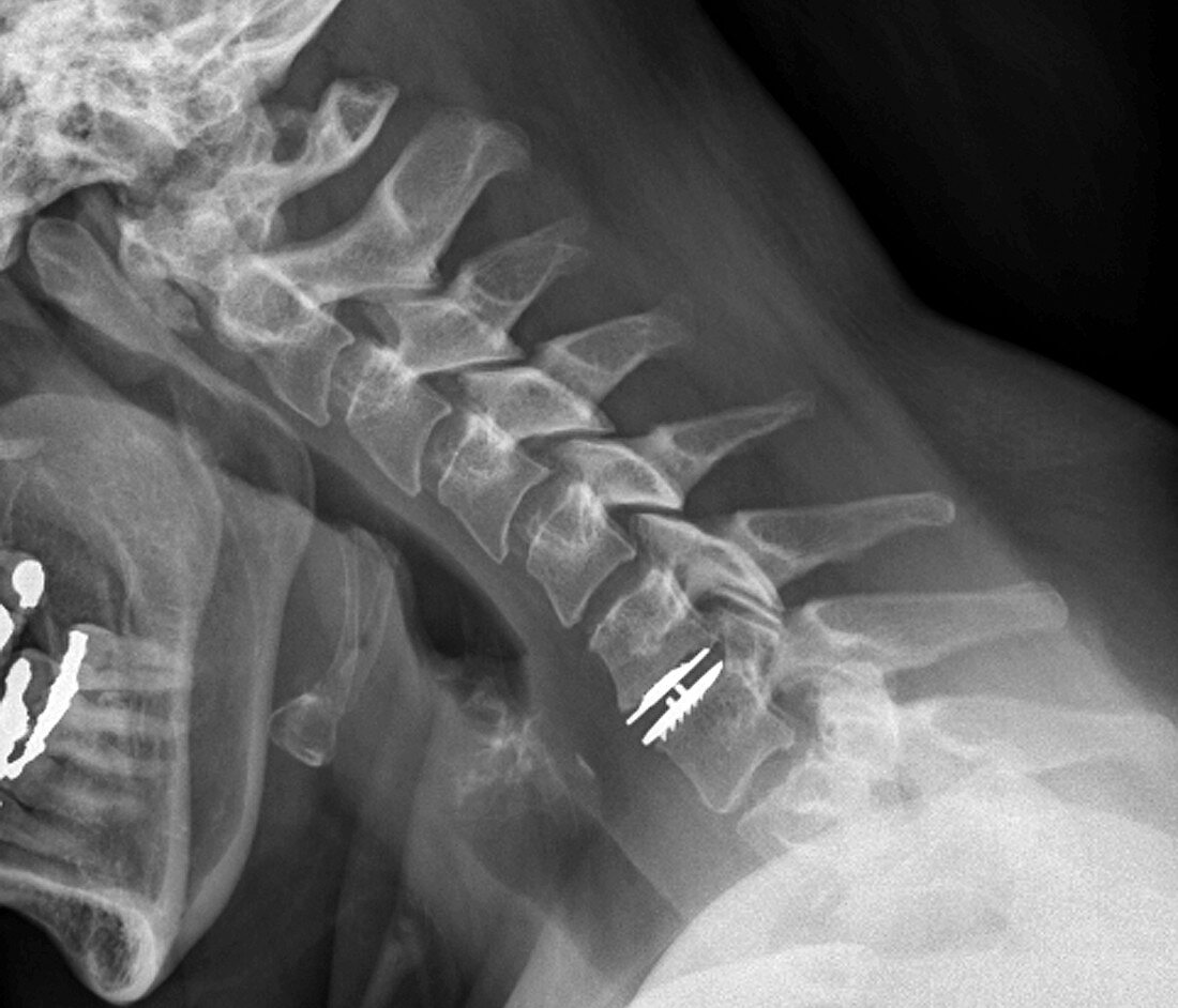 Spinal disc implant,X-ray