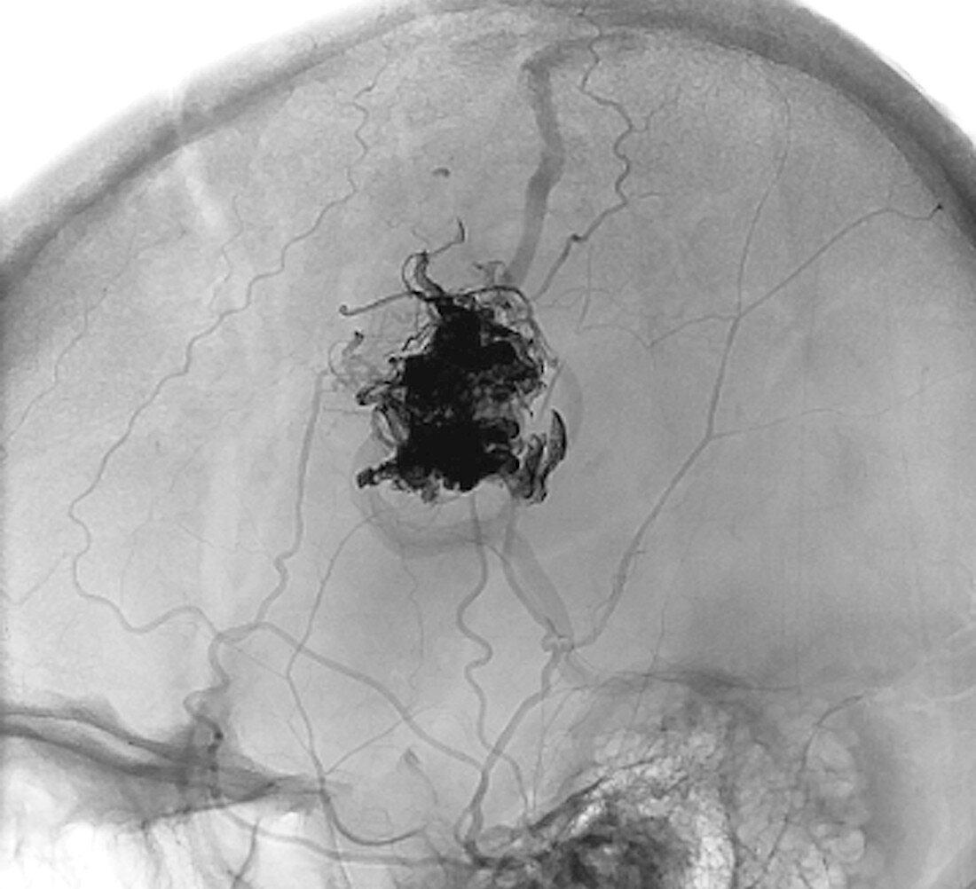 Brain blood vessel malformation,CT scan
