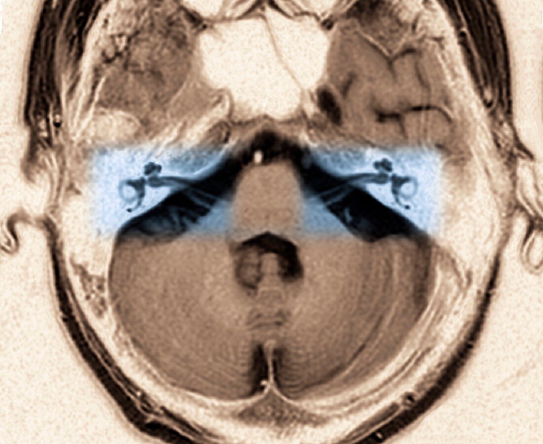 Auditory system,MRI