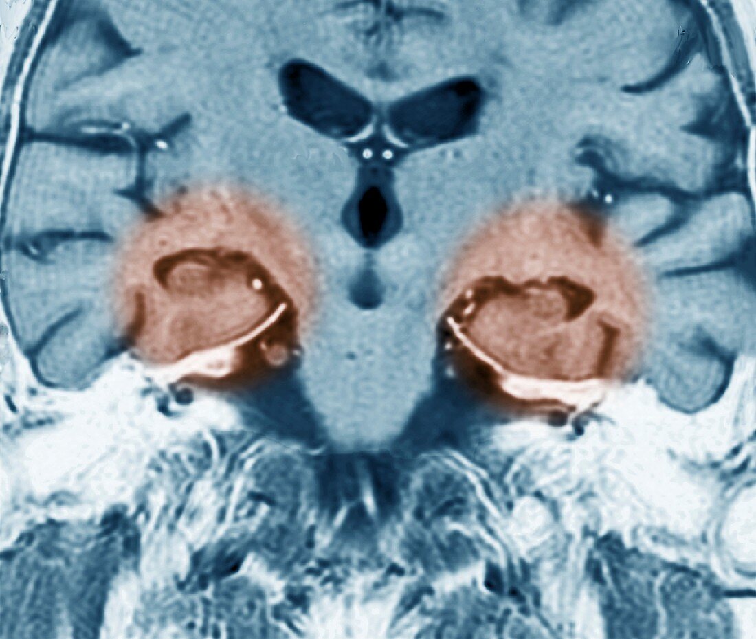 Brain and hippocampus,MRI