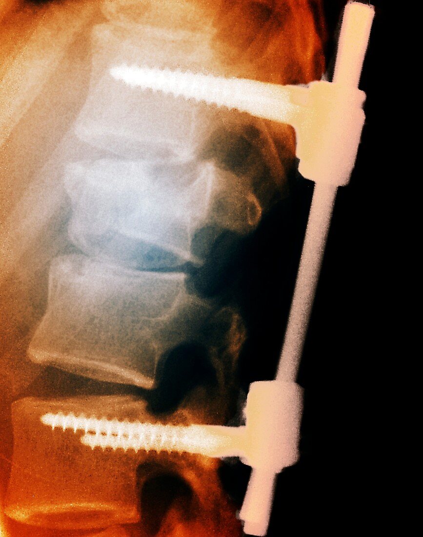 Pinned backbone,X-ray