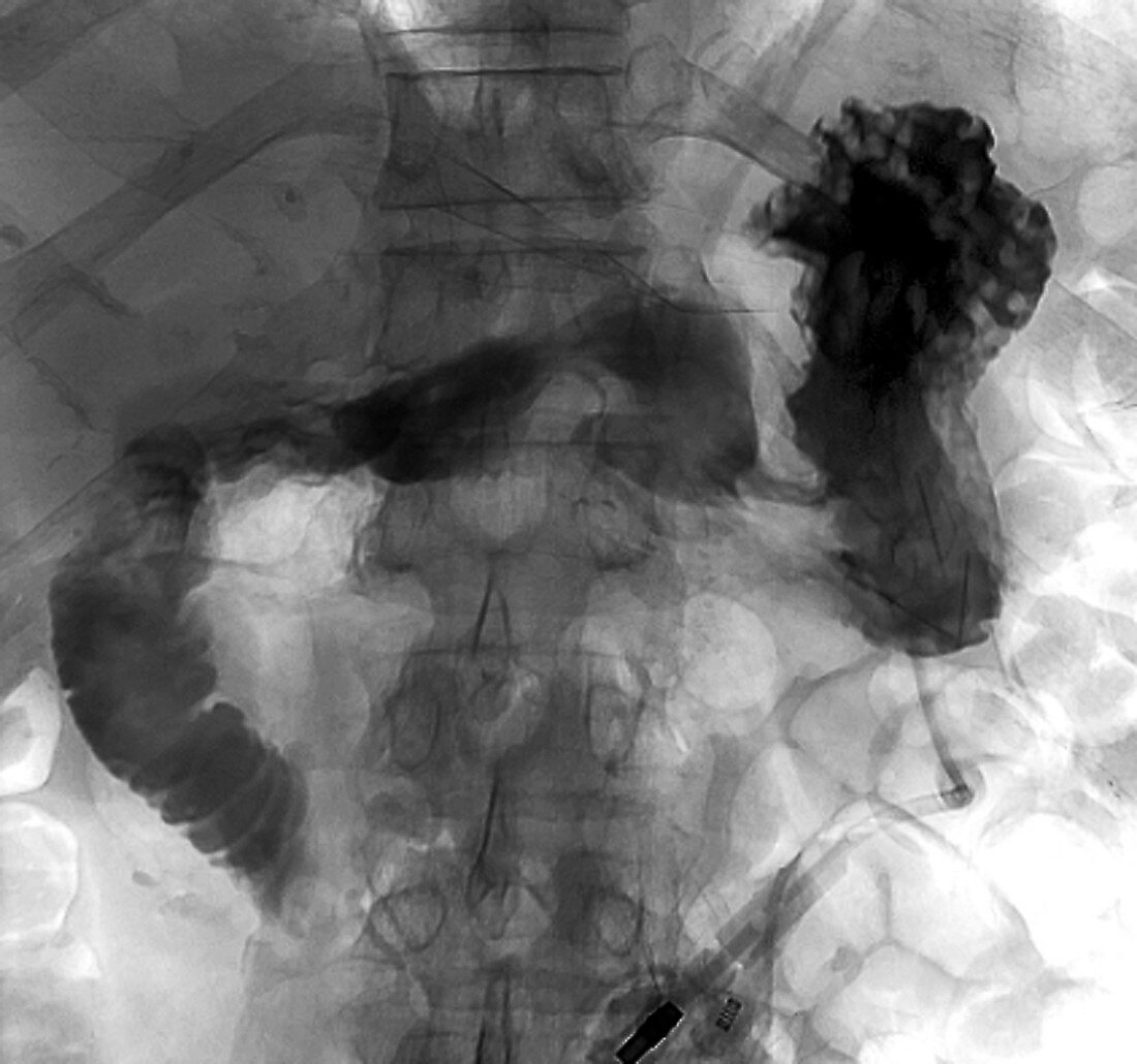 Stomach feeding tube in cancer,X-ray