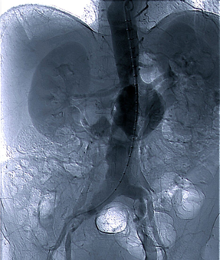 Aortic aneurysm in hypertension,X-ray