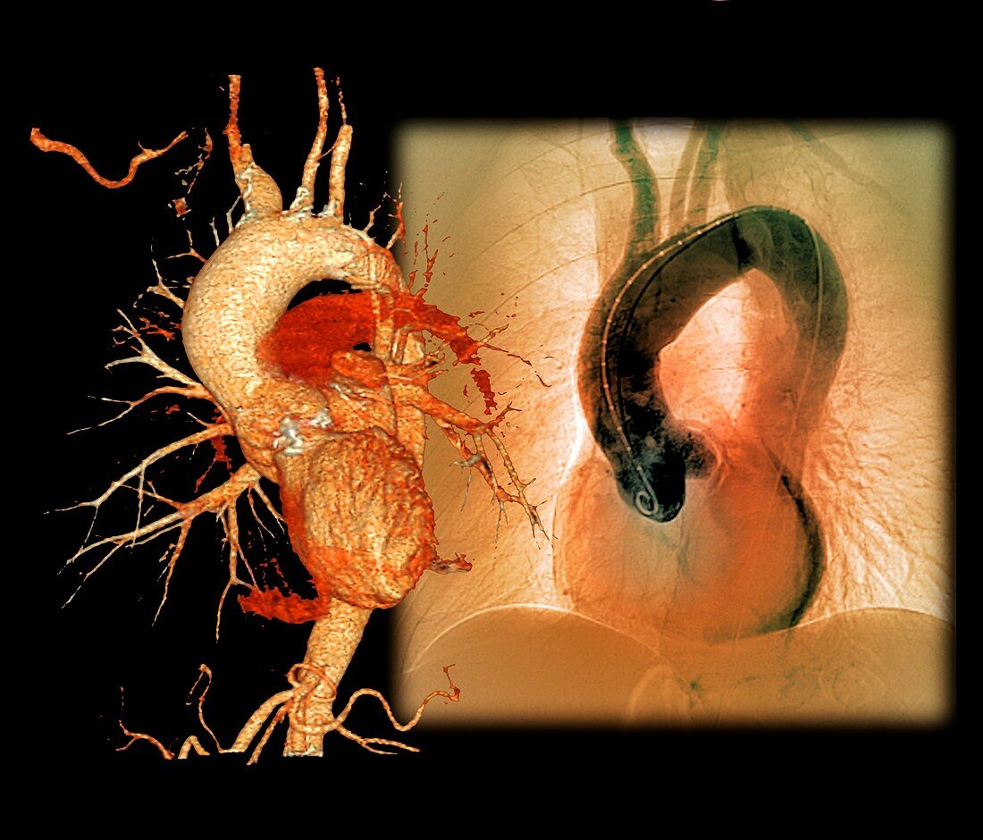 Aortic aneurysm in hypertension