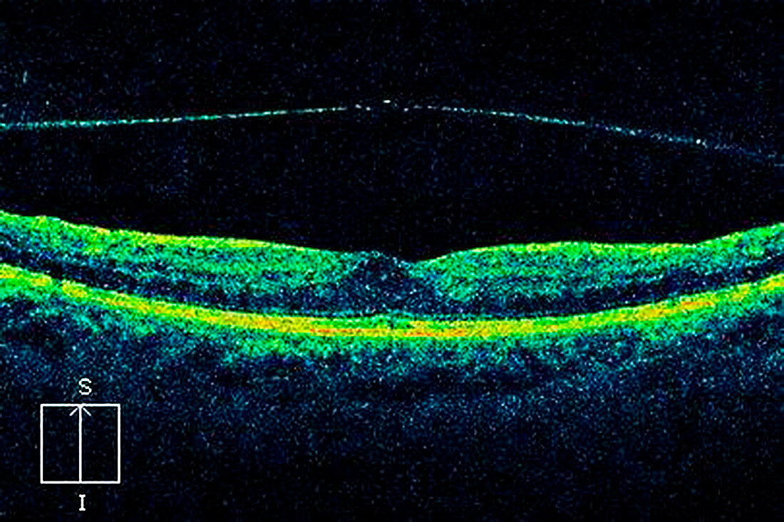 Vitreous detachment of the eye,OCT scan