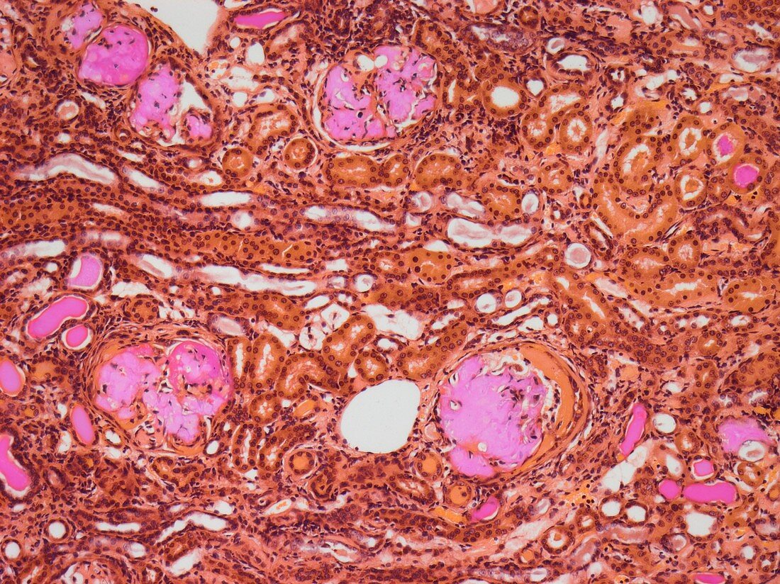 Renal amyloidosis,light micrograph