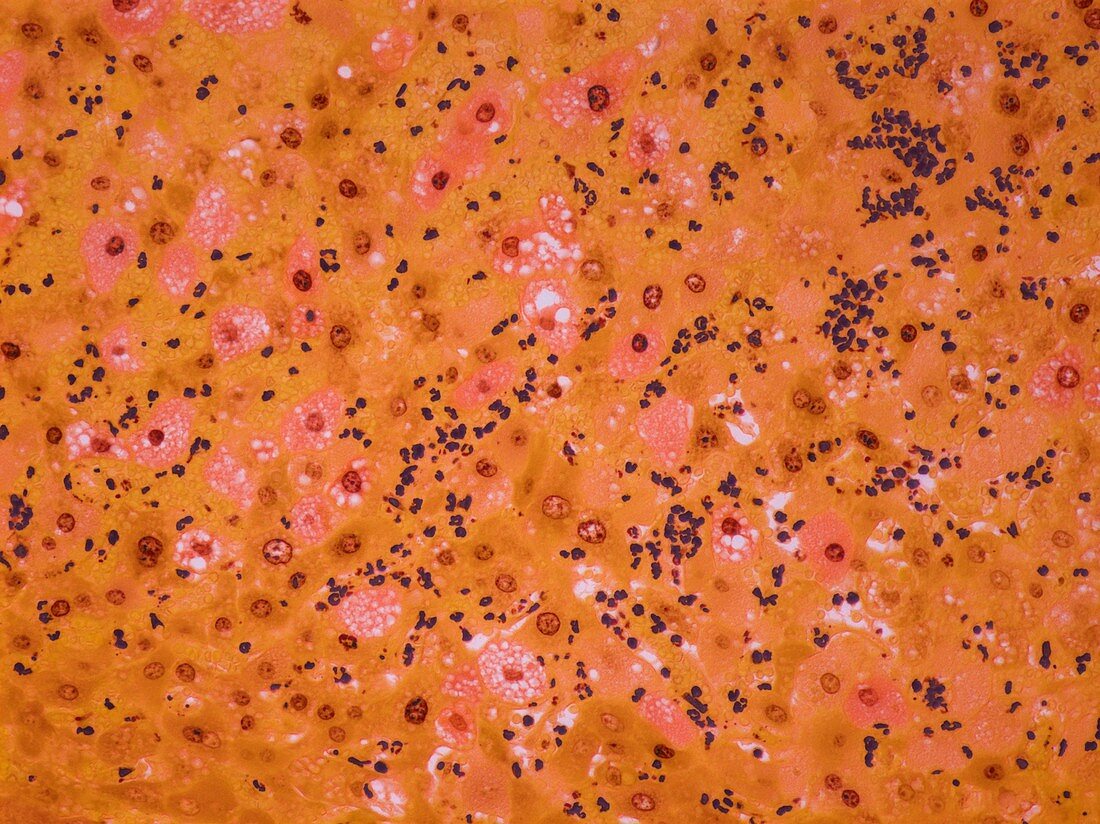 Liver cancer,light micrograph
