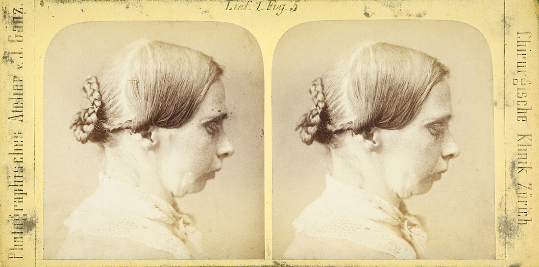 19th Century stereoscopic medical images
