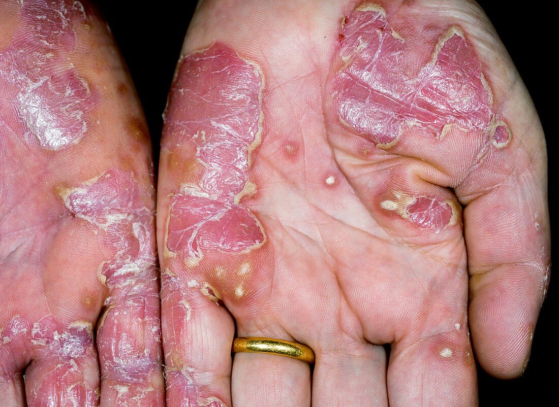 Psoriasis of the hands