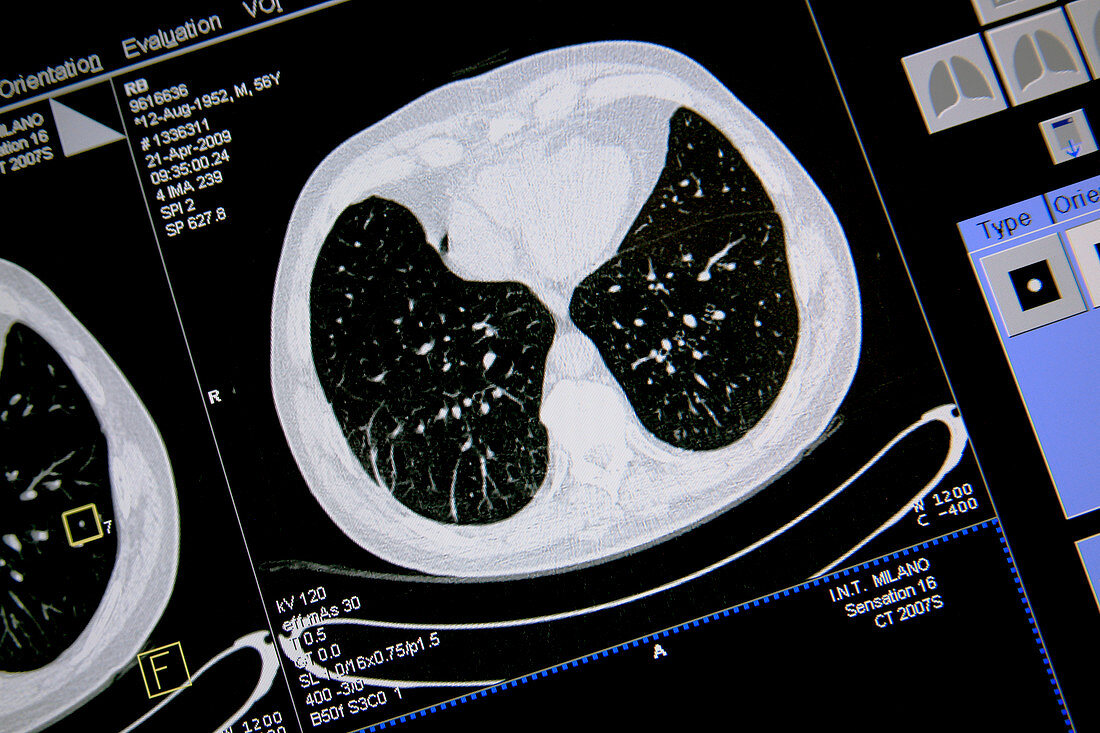 Axial lung CT scan