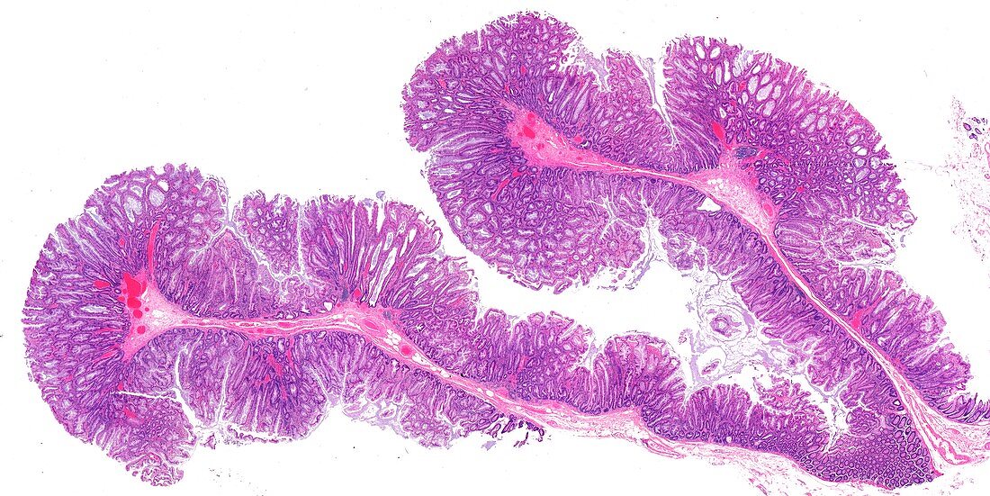 Colon polyps,light micrograph