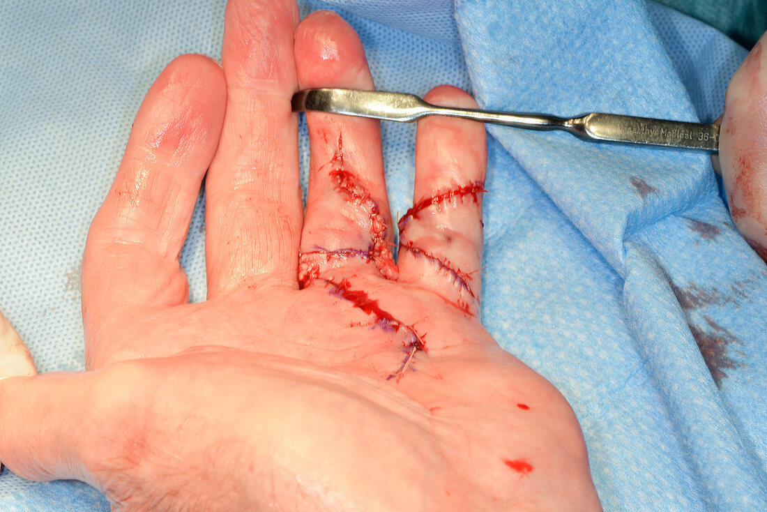 Dupuytren's contracture surgery
