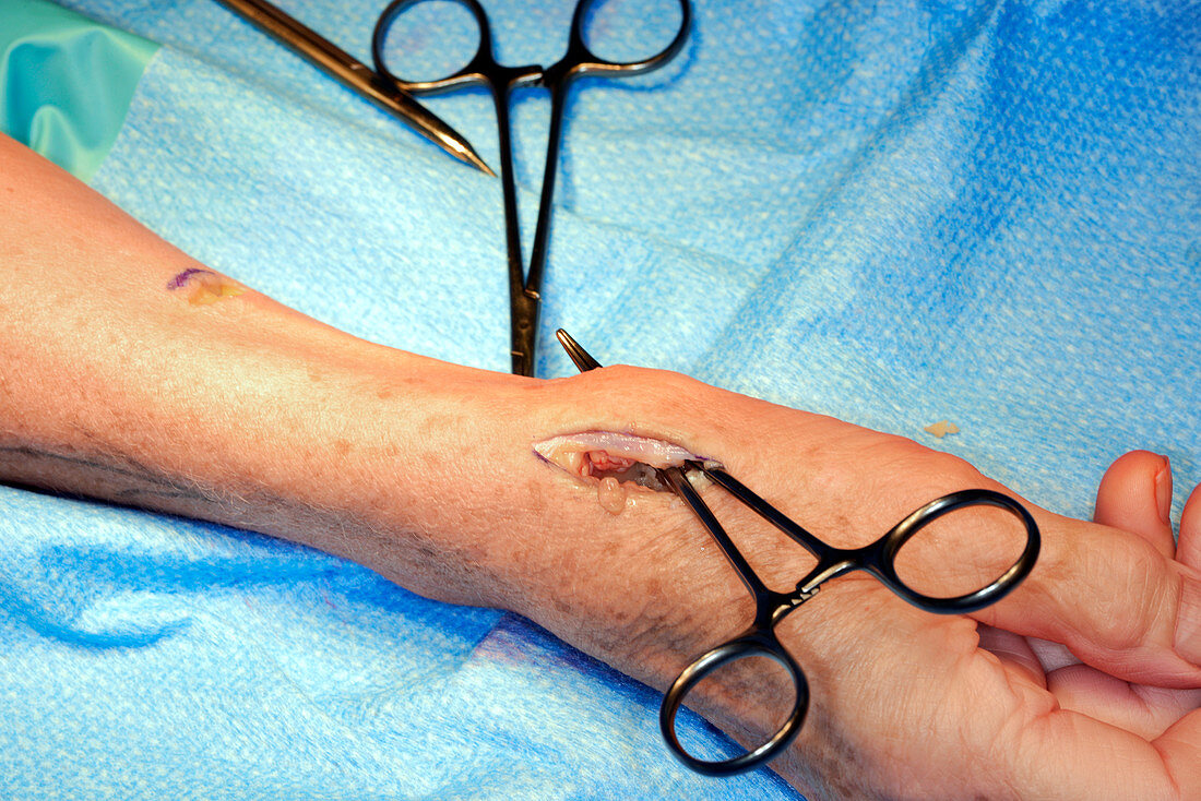Trapeziumectomy wrist operation