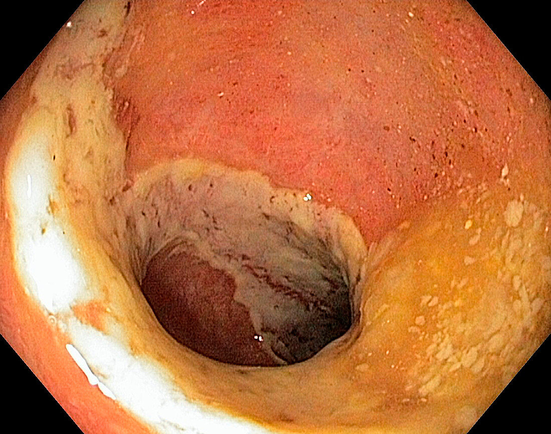 Ischaemic colitis,endoscope view