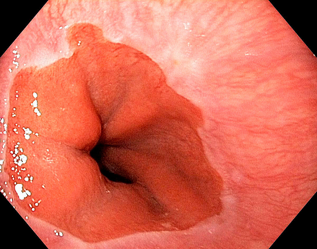 Healthy cardia of the stomach,endoscopy