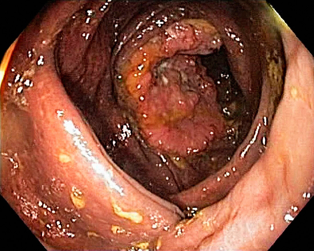 Cancer of the caecum,endoscopic view