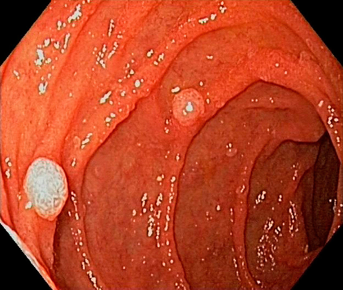 Duodenal polyps,endoscope view