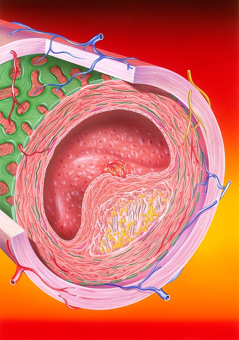 Atherosclerosis,illustration