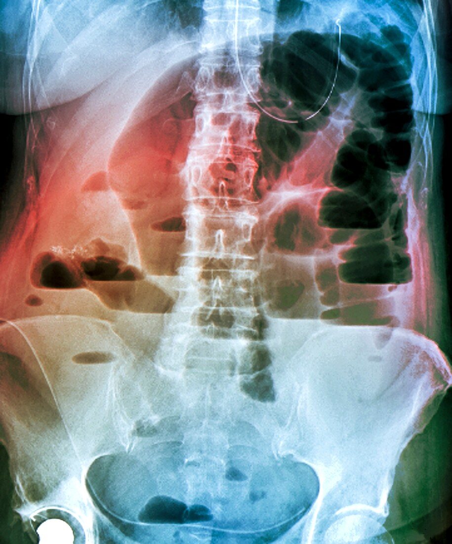 Abdominal blockage,X-ray