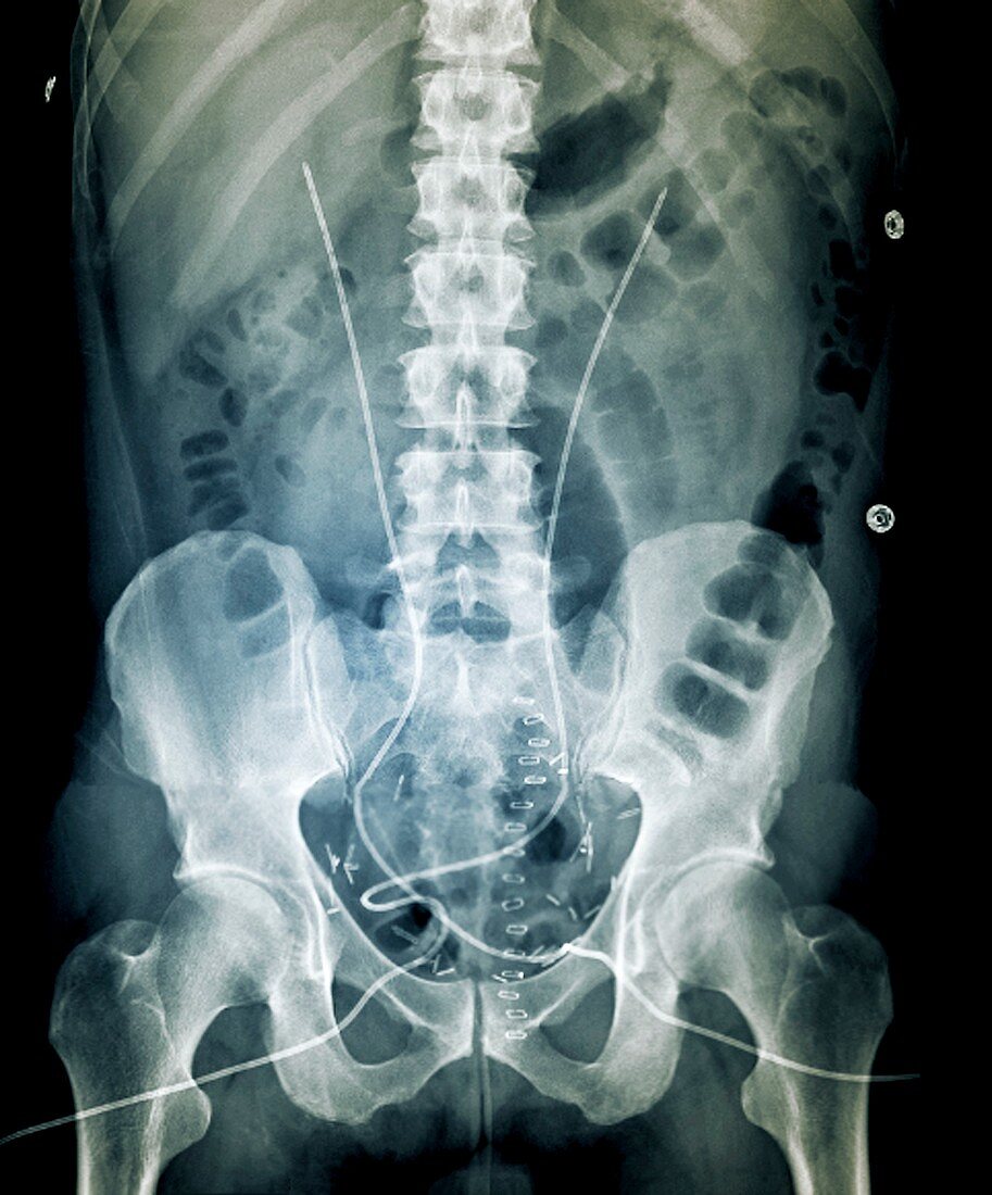 Post-operative bladder cancer,X-ray