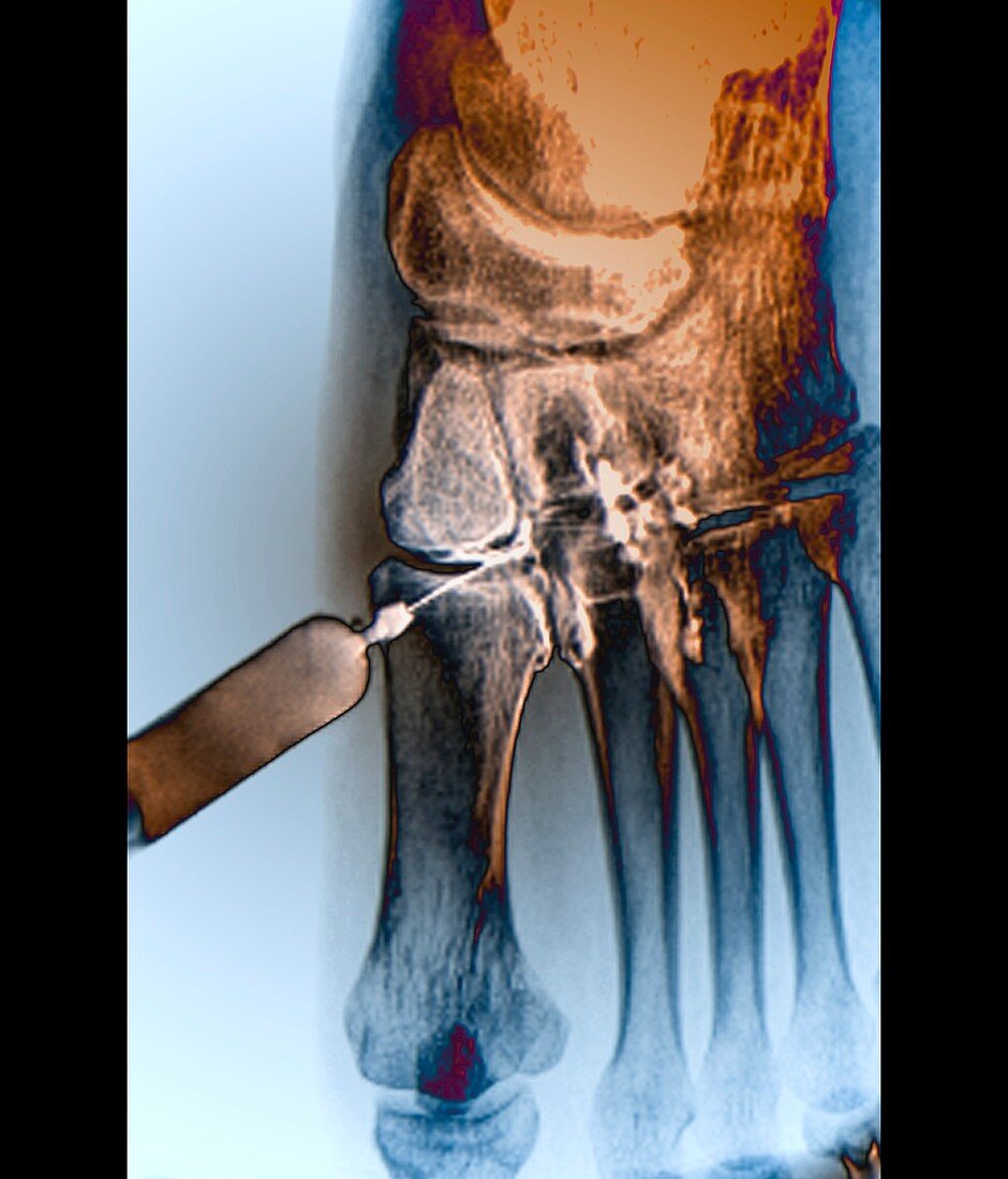 Foot pain being treated,X-ray
