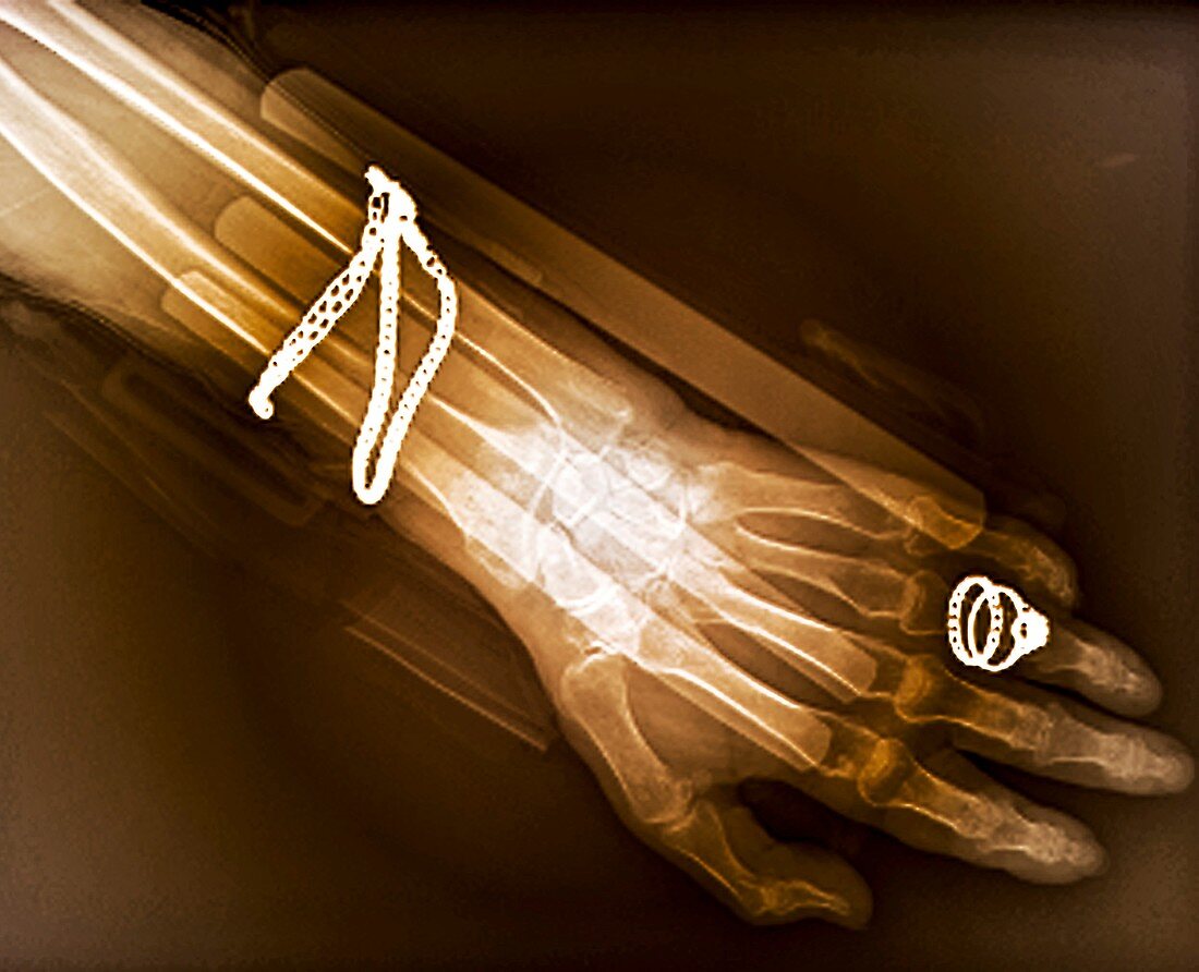 Fractured wrist,X-ray