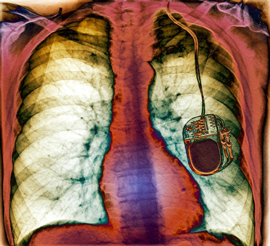 Parkinson's brain pacemaker,X-ray