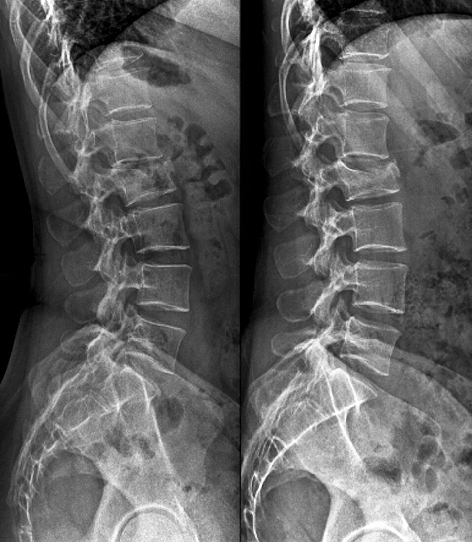 Untreated fractured vertebra,X-ray