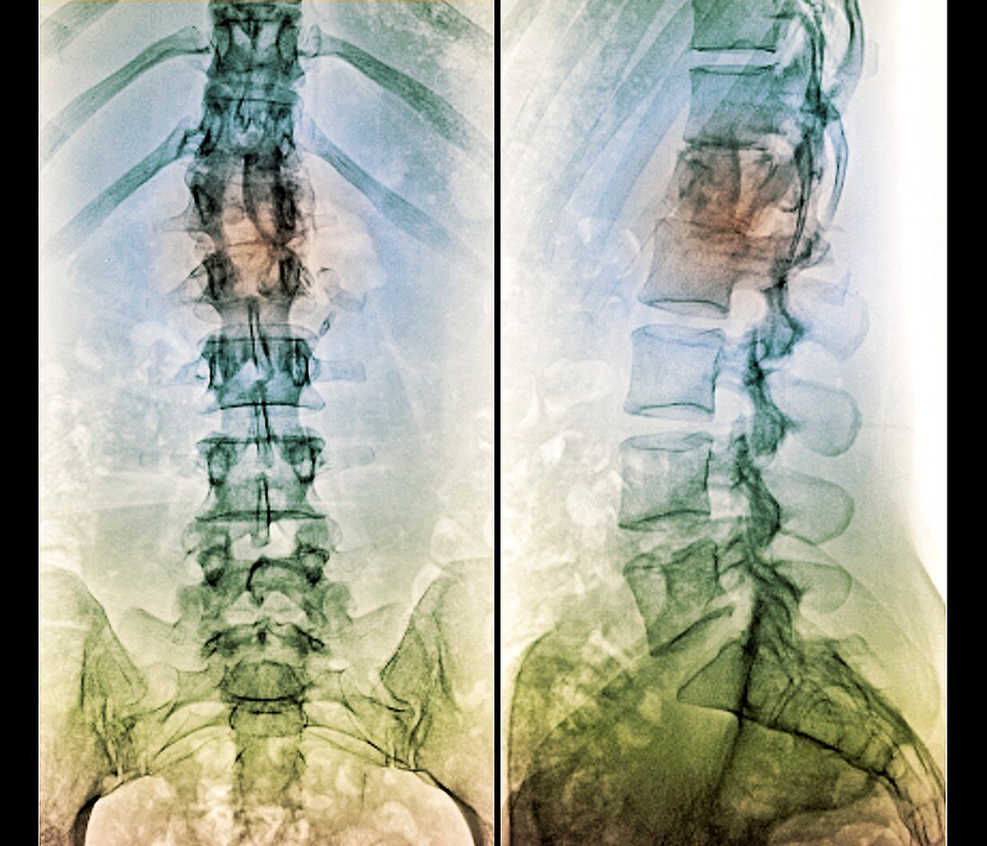 Fixed spinal fracture,X-ray