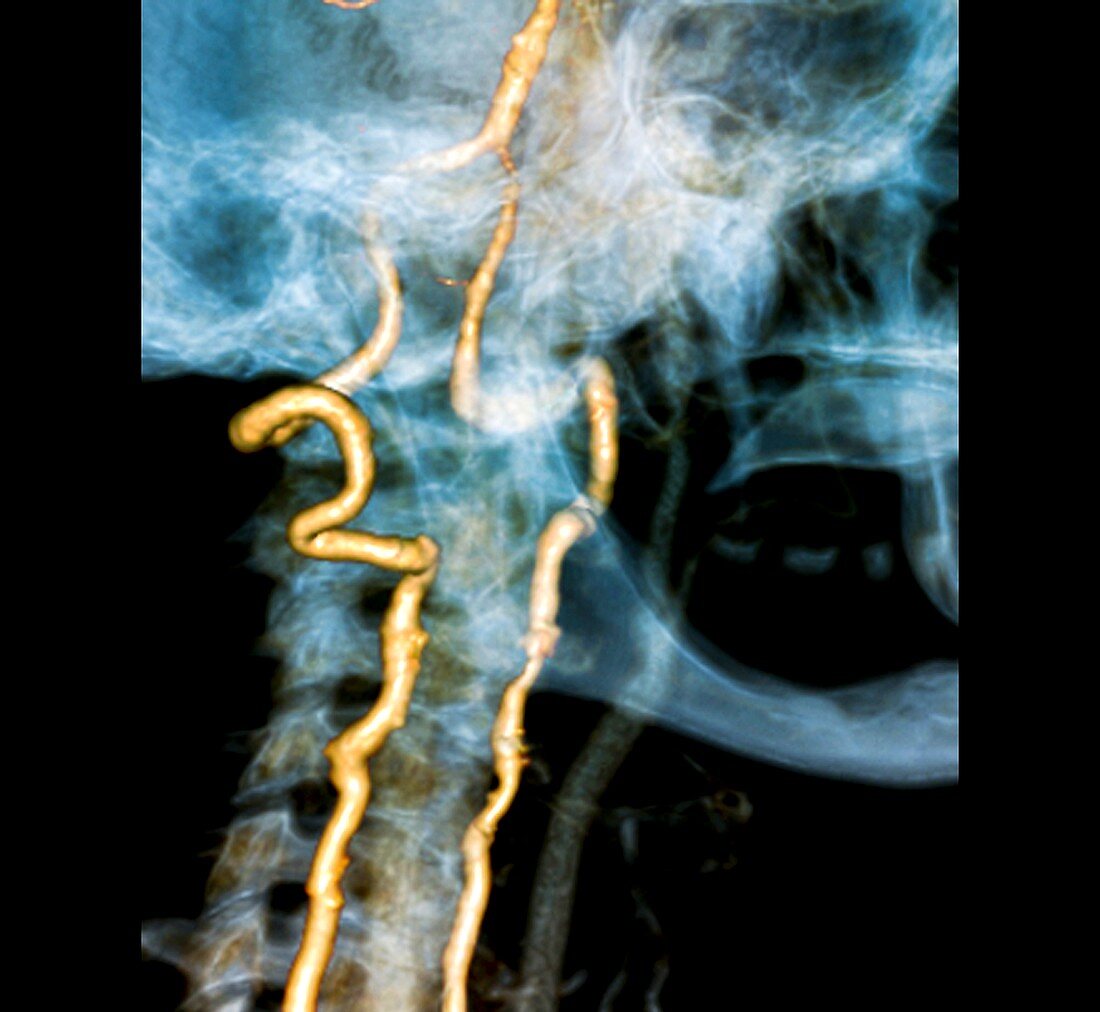 Vertebral artery insufficiency,CT scan