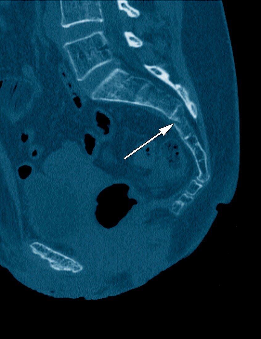 Fractured pelvis,CT scan