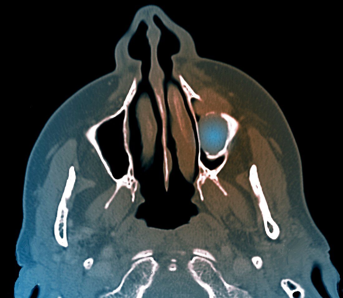 Giant cell granuloma of the jaw,CT scan