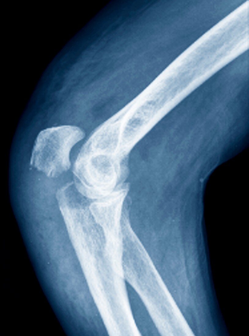 Elbow fracture,X-ray