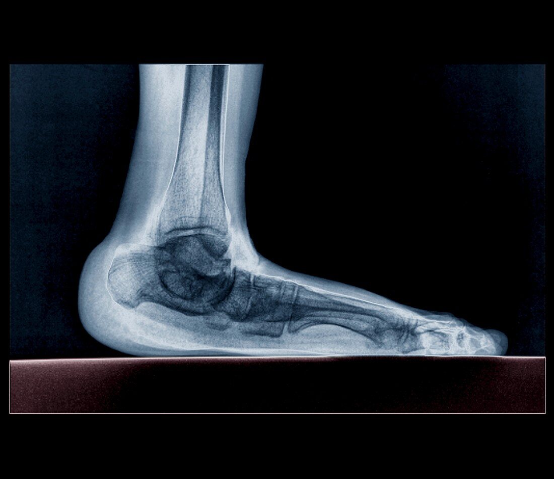 Flat foot,X-ray