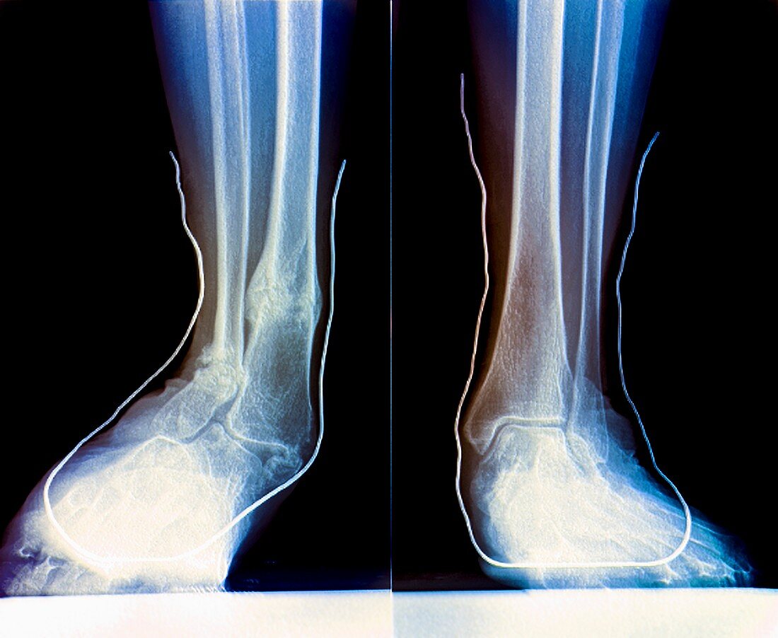 Flat feet with supports,X-ray