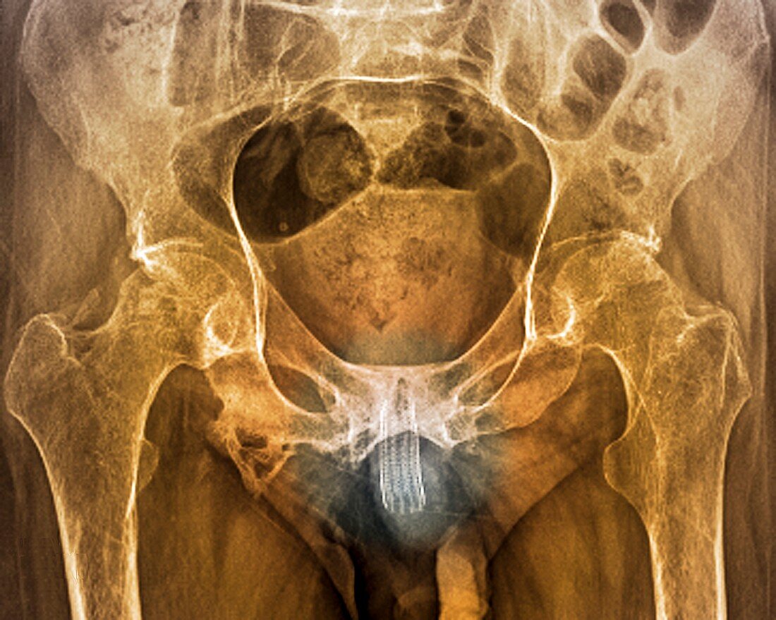 Urethral stent,Xray