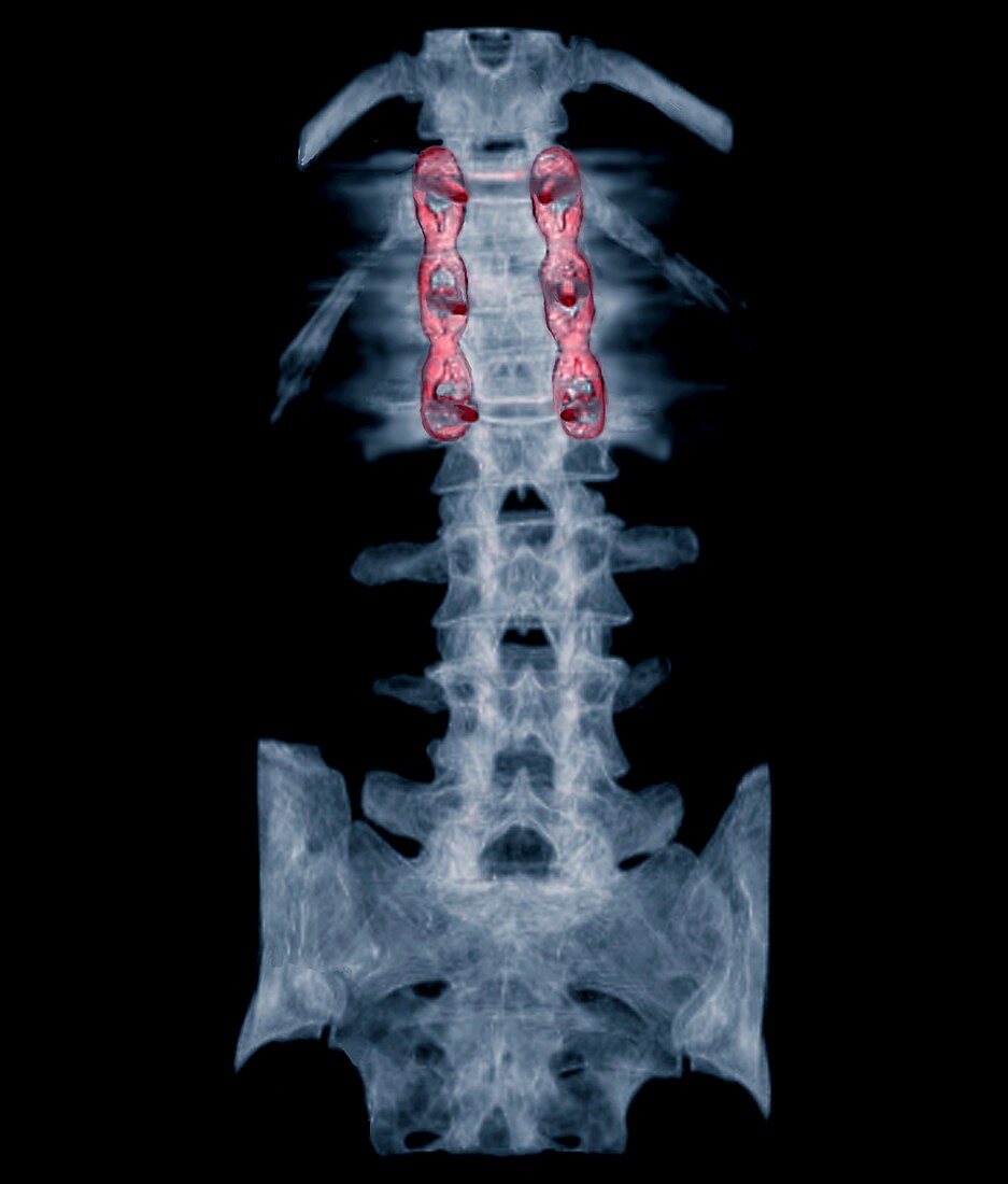 Pinned spinal fracture,X-ray