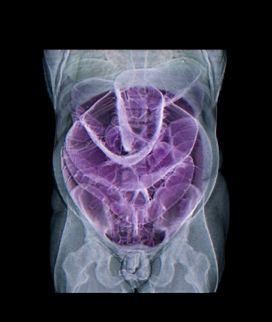 Abnormally large intestine,3D CT scan