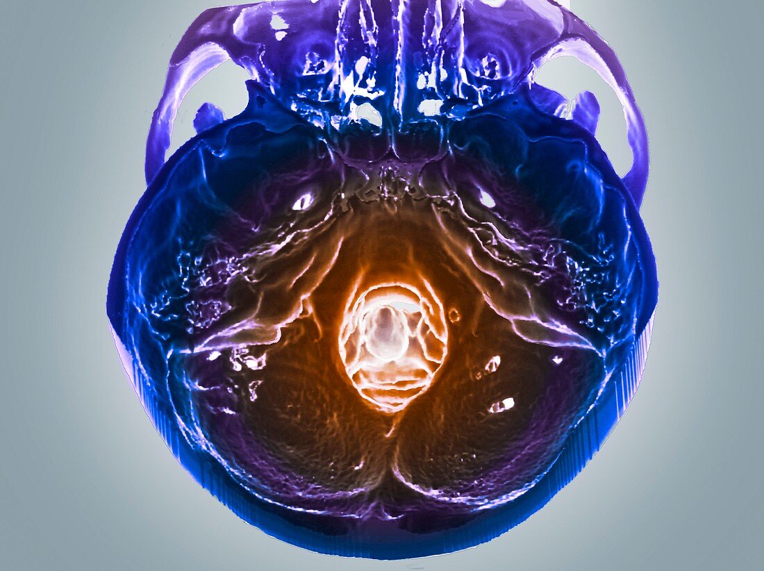 Normal skull,3D CT scan