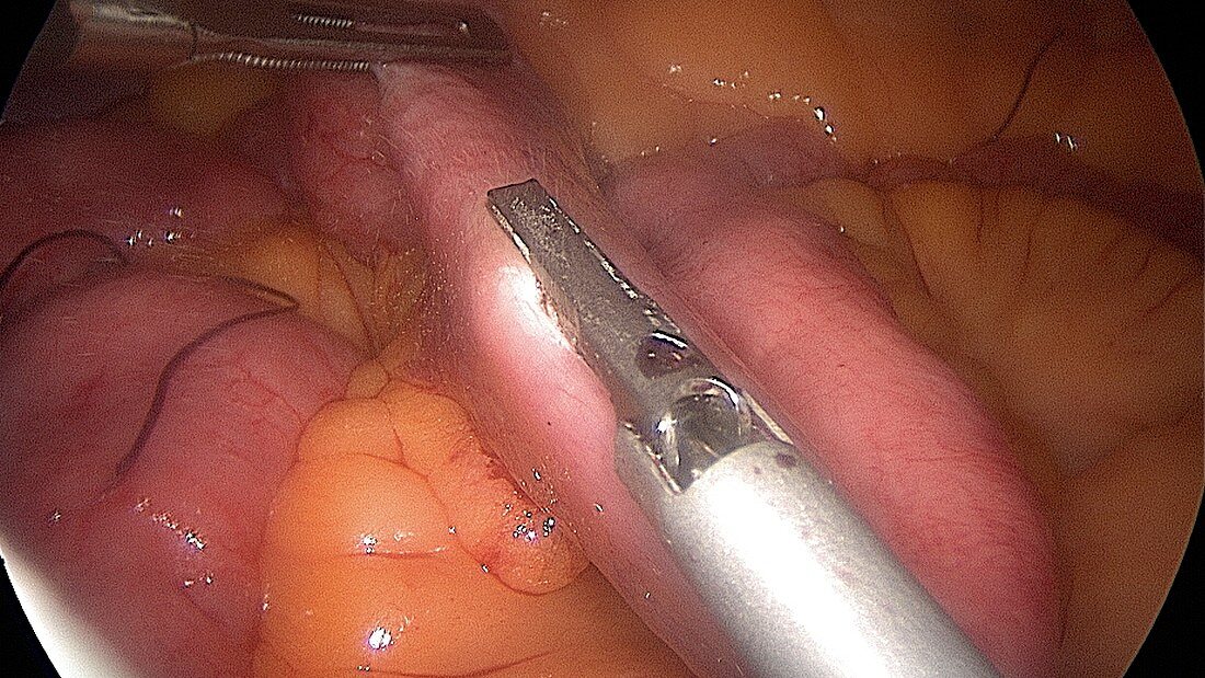 Gastric bypass surgery,endoscope view