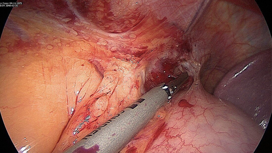 Endoscope view of abdominal surgery