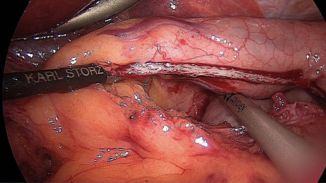 Gastric bypass surgery,endoscope view
