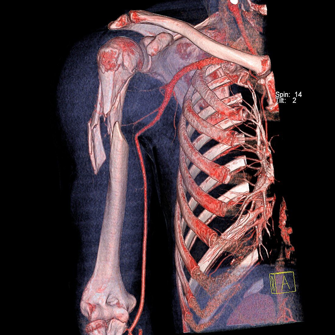 Broken upper arm bone,CT scan