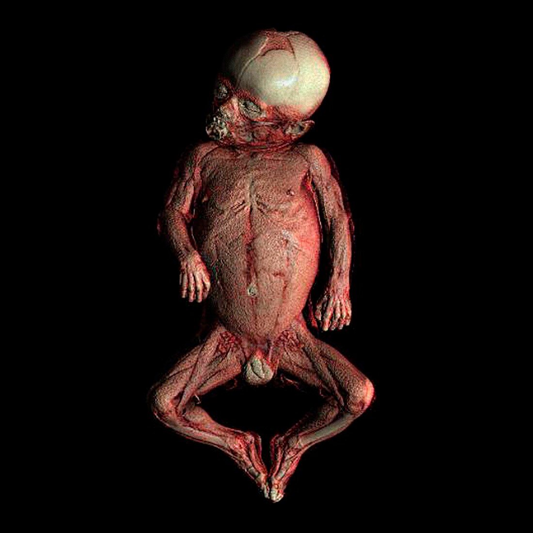 Human baby,CT scan