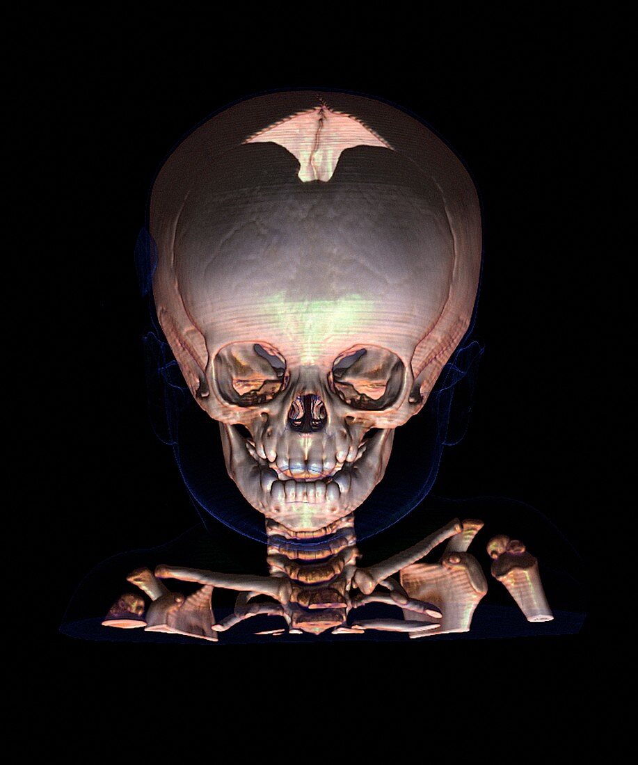 Human baby's skull,CT scan